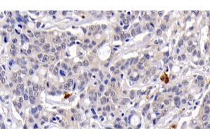 Detection of CASP3 in Human Lymphoma Tissue using Monoclonal Antibody to Caspase 3 (CASP3) (Caspase 3 抗体  (AA 29-175))