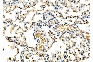 ABIN6263447 and ABIN6278081 at 1/100 staining Human lung cancer and adjacent non-tumor tissue by IHC-P. (MXD3 抗体  (Internal Region))