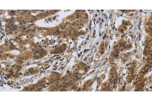 Immunohistochemistry of paraffin-embedded Human gastric cancer using IL5RA Polyclonal Antibody at dilution of 1:40 (IL5RA 抗体)