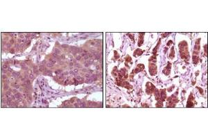 Immunohistochemical analysis of paraffin-embedded human lung carcinoma (left) and breast carcinoma (right) showing cytoplasmic localization using ERK2 mouse mAb with DAB staining. (ERK2 抗体)