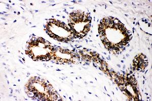 Anti- FHIT Picoband antibody, IHC(P) IHC(P): Human Mammary Cancer Tissue (FHIT 抗体  (AA 1-147))