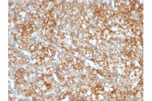 Formalin-fixed, paraffin-embedded human Renal Cell Carcinoma stained with CD147 Mouse Monoclonal Antibody (BSG/963). (CD147 抗体)
