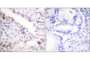 Immunohistochemistry analysis of paraffin-embedded human prostate carcinoma tissue, using Smad2 (Ab-467) Antibody. (SMAD2 抗体  (AA 418-467))
