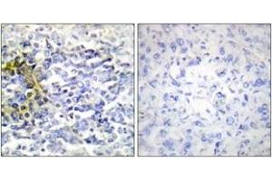 Immunohistochemistry analysis of paraffin-embedded human lung carcinoma tissue, using FXR2 Antibody. (FXR2 抗体  (AA 551-600))