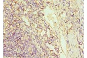Immunohistochemistry of paraffin-embedded human colon cancer using ABIN7154393 at dilution of 1:100 (Granulin 抗体  (AA 20-310))