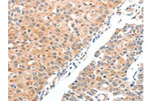 The image on the left is immunohistochemistry of paraffin-embedded Human breast cancer tissue using ABIN7128229(ADAM2 Antibody) at dilution 1/20, on the right is treated with fusion protein. (ADAM2 抗体)