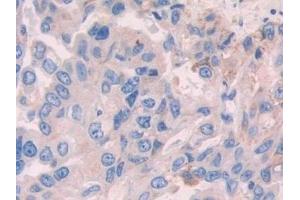 Detection of ADH1 in Human Breast cancer Tissue using Polyclonal Antibody to Alcohol Dehydrogenase 1 (ADH1)