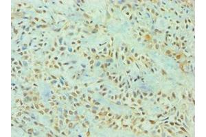 Immunohistochemistry of paraffin-embedded human breast cancer using ABIN7166926 at dilution of 1:100 (TP53I3 抗体  (AA 163-332))