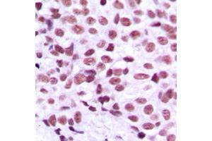 Immunohistochemical analysis of MZF1 staining in human breast cancer formalin fixed paraffin embedded tissue section. (MZF1 抗体  (N-Term))
