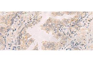 Immunohistochemistry of paraffin-embedded Human prost at e cancer tissue using TNNT1 Polyclonal Antibody at dilution of 1:35(x200) (TNNT1 抗体)