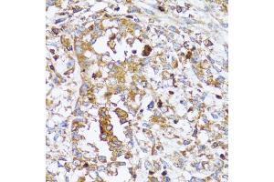 Immunohistochemistry of paraffin-embedded human uterine cancer using ACTR2 antibody (ABIN5973361) at dilution of 1/100 (40x lens). (ACTR2 抗体)