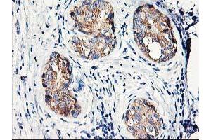 Immunohistochemical staining of paraffin-embedded Adenocarcinoma of Human breast tissue using anti-EIF2B3 mouse monoclonal antibody. (EIF2B3 抗体)