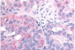 Human Ovarian Carcinoma (formalin-fixed, paraffin-embedded) stained with EGFR antibody ABIN213615 at 2. (EGFR 抗体  (C-Term))