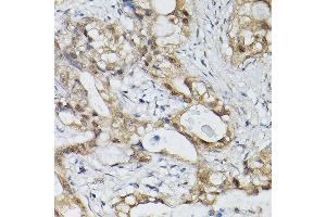 Immunohistochemistry of paraffin-embedded human lung cancer using ESE1/ELF3 Rabbit pAb (ABIN6130347, ABIN6140125, ABIN6140127 and ABIN6221990) at dilution of 1:150 (40x lens). (ELF3 抗体  (AA 1-280))