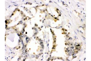 Anti- Cdk2 Picoband antibody,IHC(P) IHC(P): Human Lung Cancer Tissue