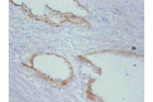Immunohistochemistry of paraffin-embedded human prostate cancer using ABIN7172200 at dilution of 1:100 (TIMP1 抗体)