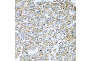Immunohistochemistry of paraffin-embedded human liver cancer using NDUFA2 antibody at dilution of 1:100 (x40 lens).