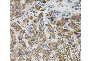 Immunohistochemistry of paraffin-embedded Human liver damage using NTF3 Polyclonal Antibody (Neurotrophin 3 抗体)