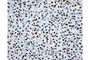 Immunohistochemical staining of paraffin-embedded Adenocarcinoma of colon tissue using anti-ARNT mouse monoclonal antibody. (ARNT 抗体)