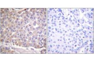 Immunohistochemistry analysis of paraffin-embedded human breast carcinoma tissue, using IRS-1 (Ab-1101) Antibody. (IRS1 抗体  (AA 1067-1116))