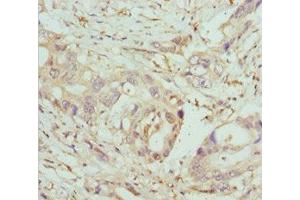Immunohistochemistry of paraffin-embedded human pancreatic cancer using ABIN7148460 at dilution of 1:100 (COG5 抗体  (AA 1-260))