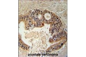 DYRK1A Antiboty (N-term) (ABIN391798 and ABIN2841652) immunohistochemistry analysis in formalin fixed and paraffin embedded human prostate carcinoma followed by peroxidase conjugation of the secondary antibody and DAB staining. (DYRK1A 抗体  (N-Term))