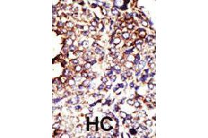 Formalin-fixed and paraffin-embedded human hepatocellular carcinoma tissue reacted with GCNT1 polyclonal antibody  , which was peroxidase-conjugated to the secondary antibody, followed by DAB staining .