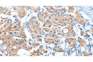 Immunohistochemistry of paraffin-embedded Human lung cancer using AUP1 Polyclonal Antibody at dilution of 1:50 (Ancient Ubiquitous Protein 1 抗体)