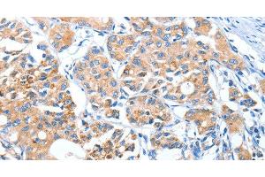 Immunohistochemistry of paraffin-embedded Human lung cancer using AUP1 Polyclonal Antibody at dilution of 1:50 (Ancient Ubiquitous Protein 1 抗体)