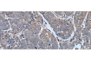 Immunohistochemistry of paraffin-embedded Human thyroid cancer tissue using TNMD Polyclonal Antibody at dilution of 1:40(x200) (TNMD 抗体)
