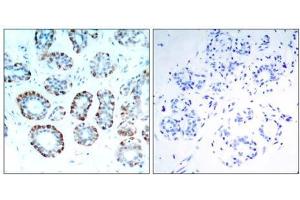 Immunohistochemical analysis of paraffin-embedded human breast carcinoma tissue, using BIM (Ab-65) antibody (E021280). (BIM 抗体)
