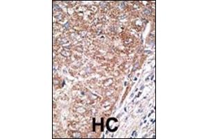 Formalin-fixed and paraffin-embedded human cancer tissue reacted with the primary antibody, which was peroxidase-conjugated to the secondary antibody, followed by DAB staining. (Nestin 抗体  (C-Term))