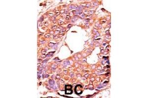 Formalin-fixed and paraffin-embedded human cancer tissue reacted with the primary antibody, which was peroxidase-conjugated to the secondary antibody, followed by AEC staining. (PPP6C 抗体  (N-Term))