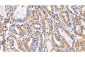 Immunohistochemistry of paraffin-embedded Human thyroid cancer tissue using Factor XIIIa Polyclonal Antibody at dilution 1:80 (F13A1 抗体)
