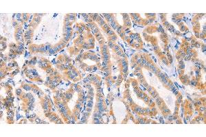 Immunohistochemistry of paraffin-embedded Human thyroid cancer tissue using Factor XIIIa Polyclonal Antibody at dilution 1:80