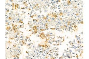ABIN7094275 and ABIN7098322 at 1/100 staining Human liver cancer by IHC-P. (HIBCH 抗体  (Internal Region))
