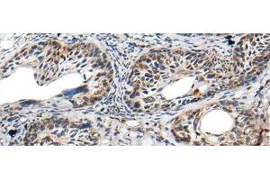 Immunohistochemistry of paraffin-embedded Human cervical cancer tissue using PRNP Polyclonal Antibody at dilution of 1:45(x200) (PRNP 抗体)