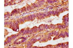 IHC image of ABIN7162317 diluted at 1:400 and staining in paraffin-embedded human colon cancer performed on a Leica BondTM system. (Osteomodulin 抗体  (AA 339-411))