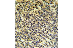 PLA2G6 Antibody IHC analysis in formalin fixed and paraffin embedded testis carcinoma followed by peroxidase conjugation of the secondary antibody and DAB staining. (PLA2G6 抗体  (AA 551-580))