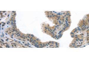 Immunohistochemistry of paraffin-embedded Human thyroid cancer tissue using VLDLR Polyclonal Antibody at dilution 1:40 (VLDLR 抗体)