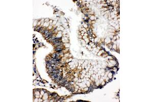 Anti-SOD2 antibody, IHC(P) IHC(P): Human Intestinal Cancer Tissue (SOD2 抗体  (N-Term))