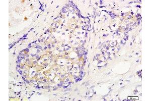 Formalin-fixed and paraffin embedded human breast cancer labeled with Anti CEP55 Polyclonal Antibody, Unconjugated  followed by conjugation to the secondary antibody and DAB staining (CEP55 抗体  (AA 151-250))