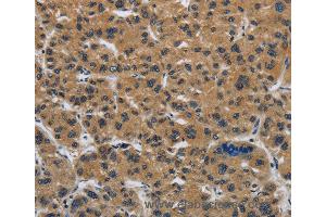 Immunohistochemistry of Human gastric cancer using CLDN2 Polyclonal Antibody at dilution of 1:50 (Claudin 2 抗体)