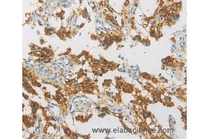 Immunohistochemistry of Human thyroid cancer using IDH3G Polyclonal Antibody at dilution of 1:30 (IDH3G 抗体)