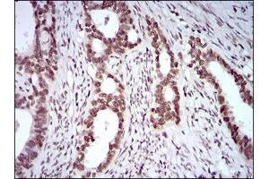 Immunohistochemical analysis of paraffin-embedded cervical cancer tissues using KHDRBS2 mouse mAb with DAB staining.