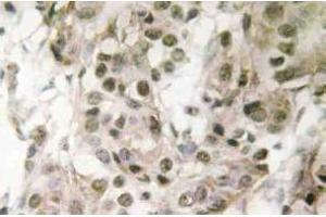 Immunohistochemistry (IHC) analyzes of Nucleophosmin antibody in paraffin-embedded human breast carcinoma tissue. (NPM1 抗体)