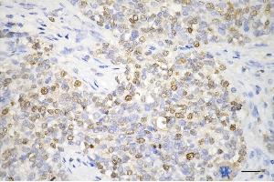 Immunohistochemistry was performed on paraffin-embedded human breast carcinoma using proliferating cell nuclear antigen antibody (ABIN7799915), 1:200).