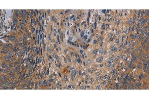 Immunohistochemistry of paraffin-embedded Human cervical cancer tissue using PARP10 Polyclonal Antibody at dilution 1:30 (PARP10 抗体)
