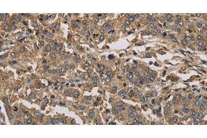 Immunohistochemistry of paraffin-embedded Human liver cancer using KIF22 Polyclonal Antibody at dilution of 1:30 (KIF22 抗体)