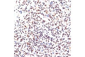 Immunohistochemistry of paraffin-embedded human breast cancer using P Rabbit mAb (ABIN7269156) at dilution of 1:100 (40x lens). (PAX9 抗体)